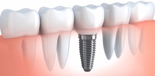 Dental Implants, Surrey Dentist